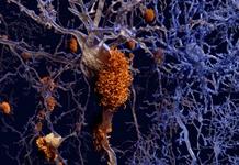 Drawing of neurons affected by plaques of Alzheimer's disease